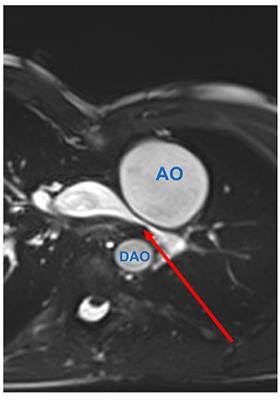 Cardiac Imaging in Patients After Fontan Palliation: Which Test and When?